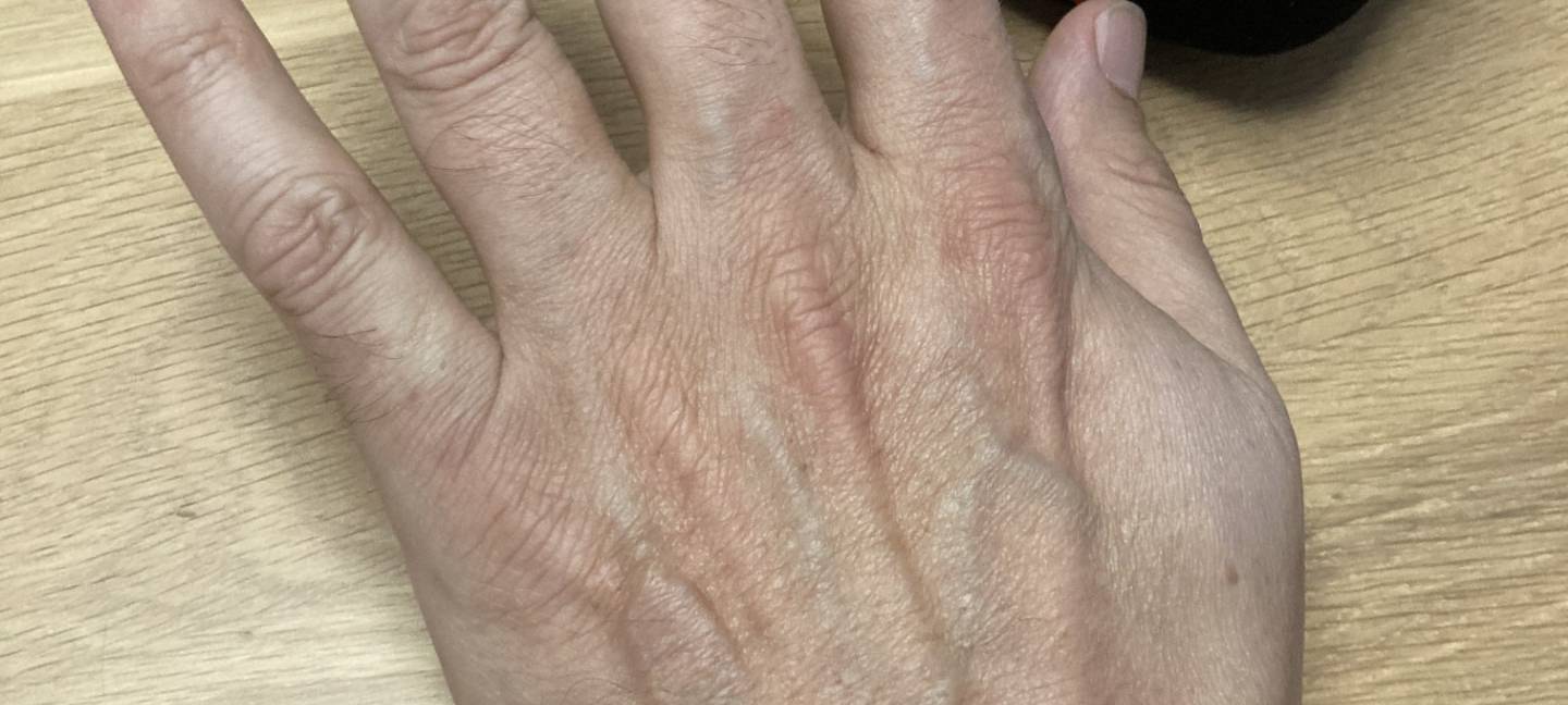 Kreditkarte als Chip unter der Haut