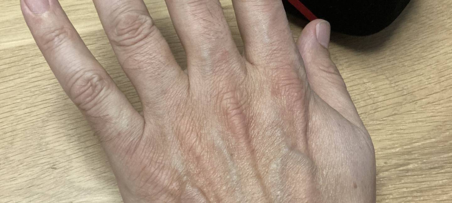 Kreditkarte als Chip unter der Haut